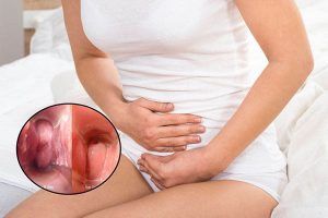 Điều trị dứt điểm viêm loét cổ tử cung bằng cách nào?
