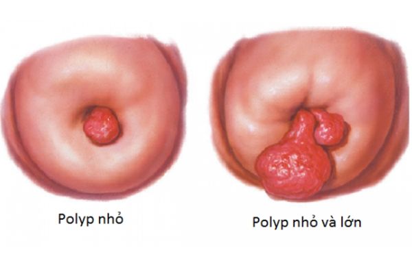 Polyp cổ tử cung gây ảnh hưởng đến khả năng sinh sản của người bệnh