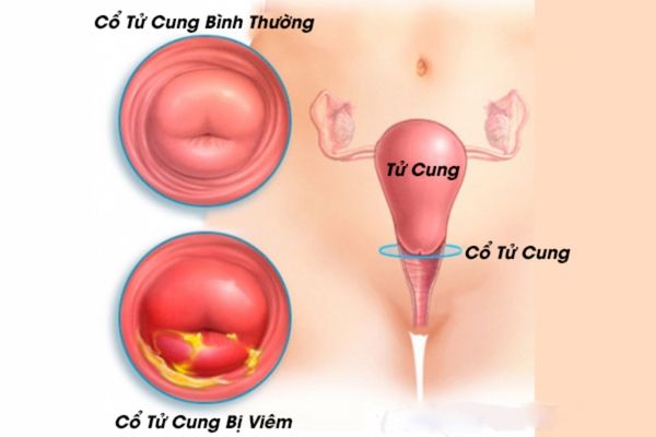 Viêm cổ tử cung điều trị không hiệu quả có thể dẫn đến vô sinh, hiếm muộn