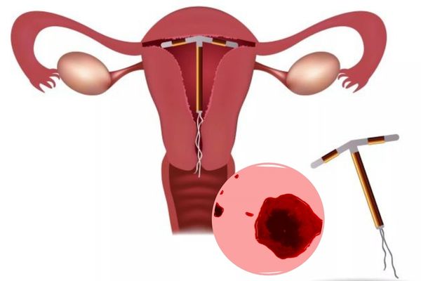 Đặt vòng tránh thai có thể gây rong kinh ở nữ giới