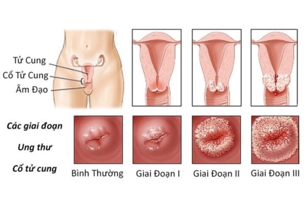 Khám âm đạo là phương pháp chủ động bào vệ sức khỏe sinh sản của nữ giới