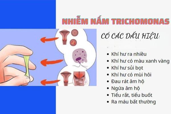Triệu chứng nhận biết nhiễm nấm Trichomonas