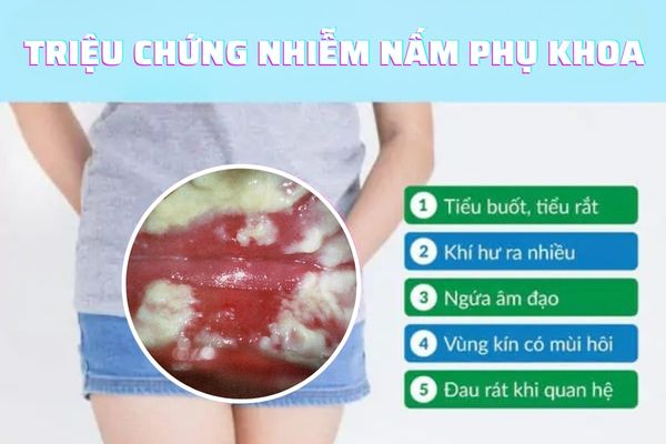 Các triệu chứng thường gặp khi nhiễm nấm phụ khoa ở nữ giới