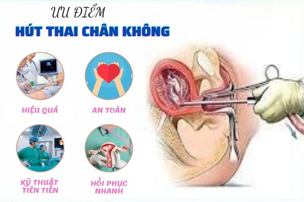 Hút thai chân không là phương pháp có nhiều ưu điểm nổi bật