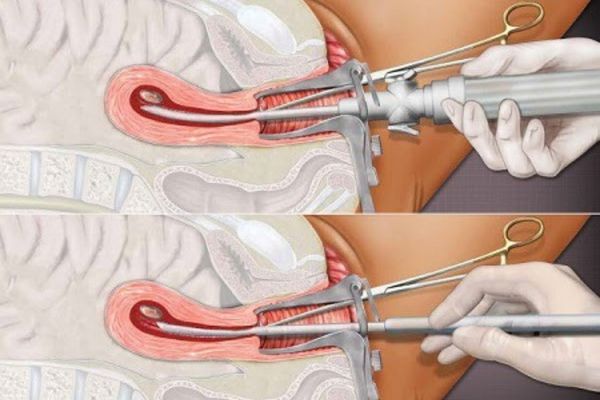 Phá thai bằng phương pháp hút thai được áp dụng phổ biến