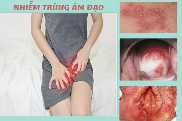 Nhiễm trùng âm đạo gây ra tình trạng quan hệ đau rát, khó chịu