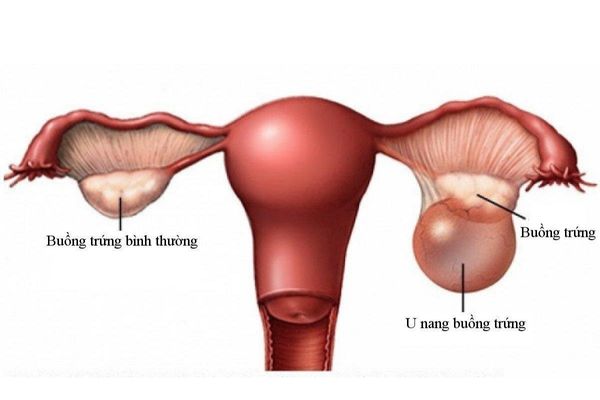 U nang buồng trứng có thể là nguyên nhân gây chậm kinh ở nữ giới