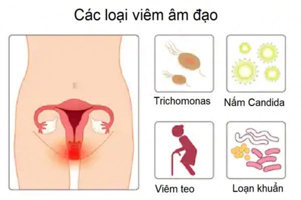 Viêm âm đạo là bệnh lý phụ khoa phổ biến ở nữ giới