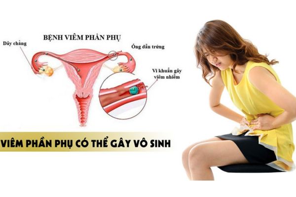 Viêm phần phụ ở nữ giới có thể gây vô sinh