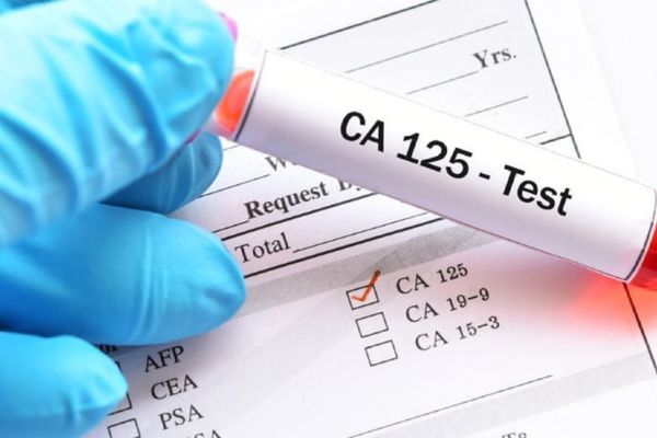 Phương pháp xét nghiệm CA - 125