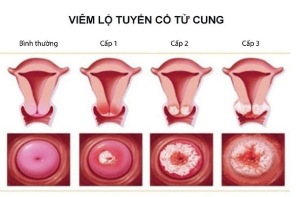 Bệnh viêm lộ tuyến cổ tử cung khiến âm đạo ra máu màu nâu