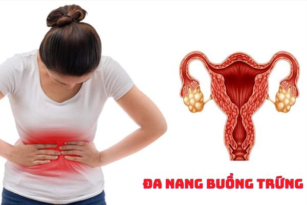 Hội chứng đa nang buồng trứng dẫn đến đau bụng kinh