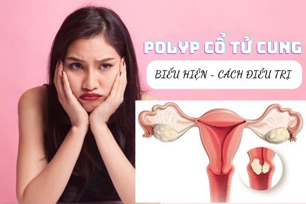 Polyp cổ tử cung – Dấu hiệu nhận biết và cách điều trị dứt điểm
