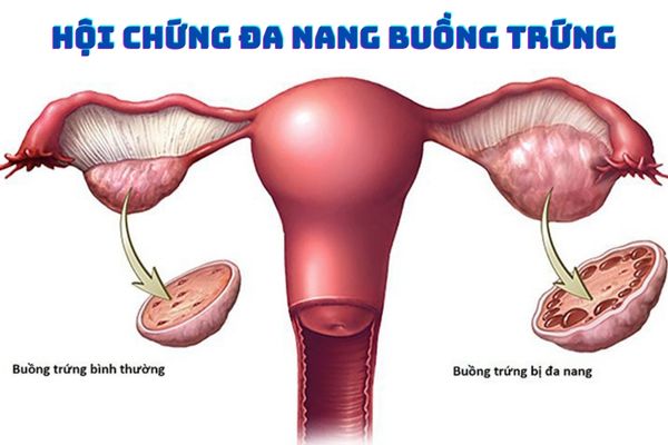 Hội chứng đa nang buồng trứng có thể gây rối loạn kinh nguyệt