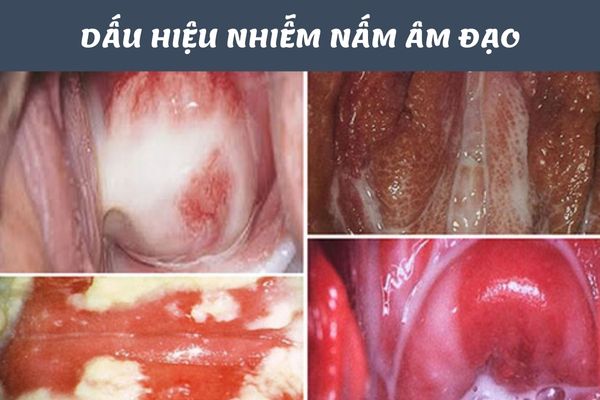 Dấu hiệu nhận biết nấm âm đạo ở nữ giới