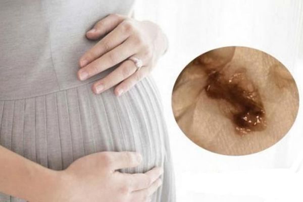 Ra dịch nâu trước kỳ kinh là dấu hiệu nhận biết mang thai sớm