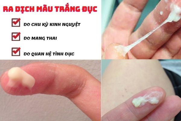 Nguyên nhân sinh lý tiết ra dịch màu trắng đục