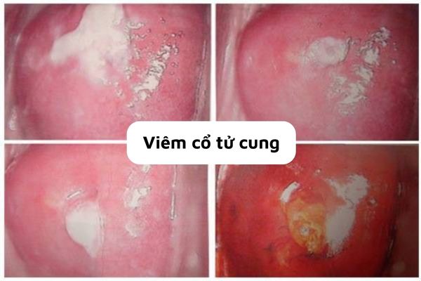 Cac-benh-phu-khoa-ma-chi-em-phu-nu-thuong-gap-4