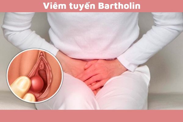 Tổng hợp những thông tin về viêm tuyến Bartholin