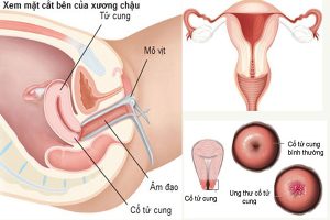 Tầm quan trọng của sinh thiết cổ tử cung ở nữ giới