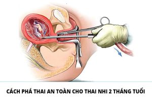 Phá thai dưới 2 tháng tuổi bằng cách nào an toàn?