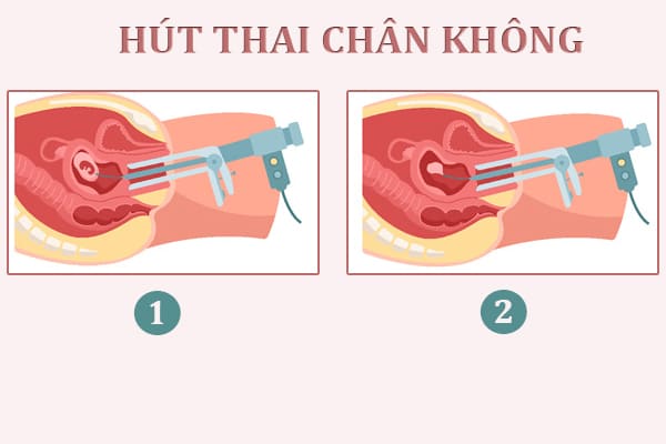Hut-thai-chan-khong-thuong-duoc-chi-dinh-cho-thai-tu-2-den5-thang-tuoi