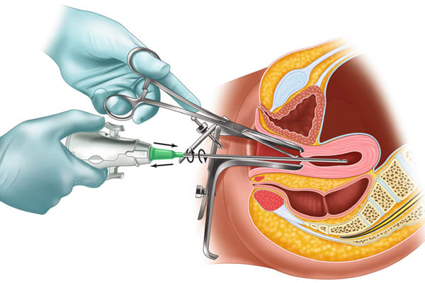 Phuong-phap-hut-thai-thuong-duoc-ap-dung-cho-truong-hop-mang-thai-tu-3-4-tuan-tuoi