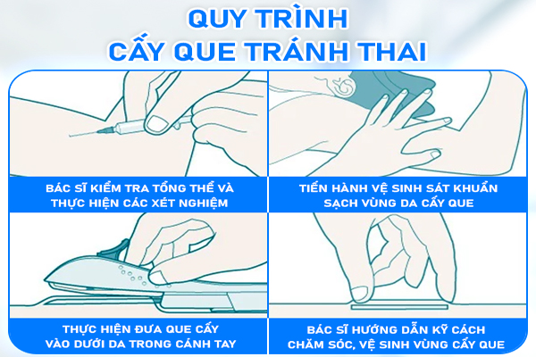 Quy trình cấy que tránh thai đạt chuẩn y tế tại Trường Hải