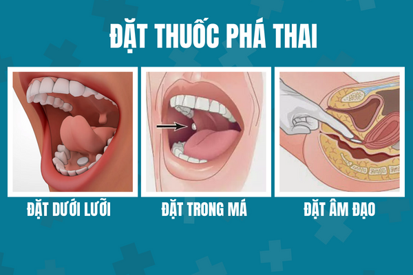 Phuong-phap-dat-thuoc-pha-thai-1