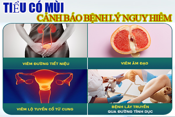 5 nguyên nhân khiến nước tiểu có mùi - Dấu hiệu đáng lo ngại