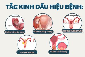 Tắc kinh nguyệt – Cảnh báo điều gì ở sức khỏe nữ giới