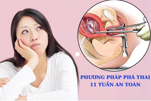 Thực hiện phá thai 11 tuần bằng biện pháp nào?