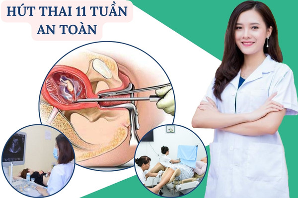 Hút thai 11 tuần