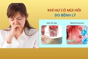 Khí hư có mùi hôi nguy hiểm không cách điều trị