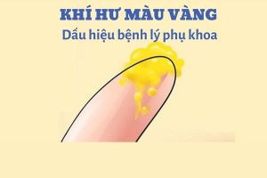 Khí hư màu vàng và cách điều trị hiệu quả