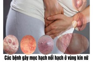 Nổi hạch vùng kín cho biết mắc bệnh gì?