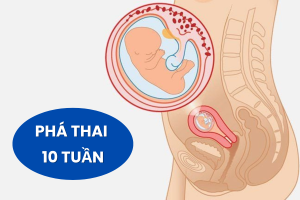 Phá thai 10 tuần ở đâu an toàn, ít tốn kém?