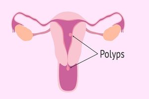 Khám chữa polyp cổ tử cung ở đâu có bác sĩ giỏi, hiệu quả cao?