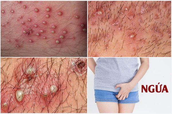 Bi-viem-nang-long-vung-kin-nu-1