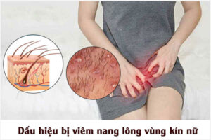 Bị viêm nang lông vùng kín nữ phải làm sao?