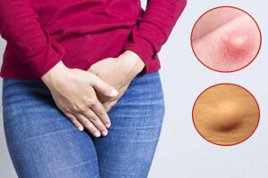 Nữ giới bị nổi hạch vùng kín là dấu hiệu của bệnh gì?