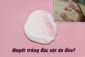 Huyết trắng đặc sệt là do đâu? Cách chữa ra sao?