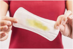 Huyết trắng màu vàng là do đâu? Có nguy hiểm không?