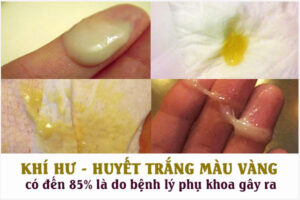 Ra dịch vàng, có mùi ở vùng kín là dấu hiệu của bệnh gì?
