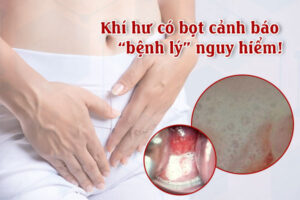 Khí hư có bọt là bị gì? Cách khắc phục hiệu quả