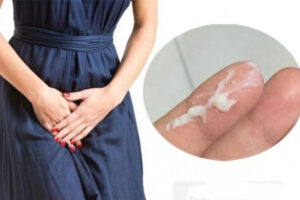 Ra dịch trắng: Nguyên nhân và Cách xử lý hiệu quả