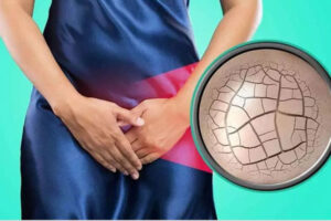 Bị khô vùng kín: Biểu hiện, Nguyên nhân và Cách khắc phục hiệu quả