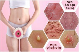 Nổi mụn nước âm đạo là dấu hiệu của bệnh gì?