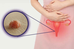 Nổi mụn ở hột le là bị gì?