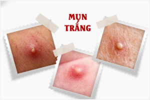 Nổi mụn trắng ở âm đạo là bệnh gì?